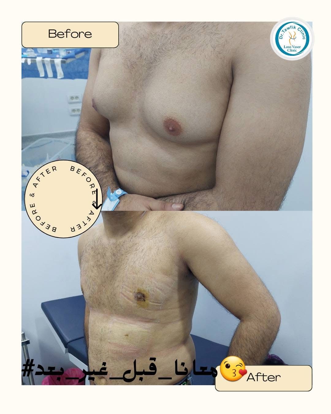 صورة قبل وبعد من ألبوم حالات علاج التثدي — الحالة 06