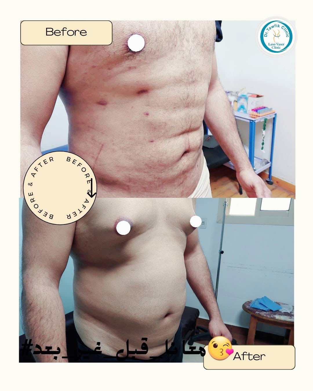 صورة قبل وبعد من ألبوم حالات علاج التثدي — الحالة 08