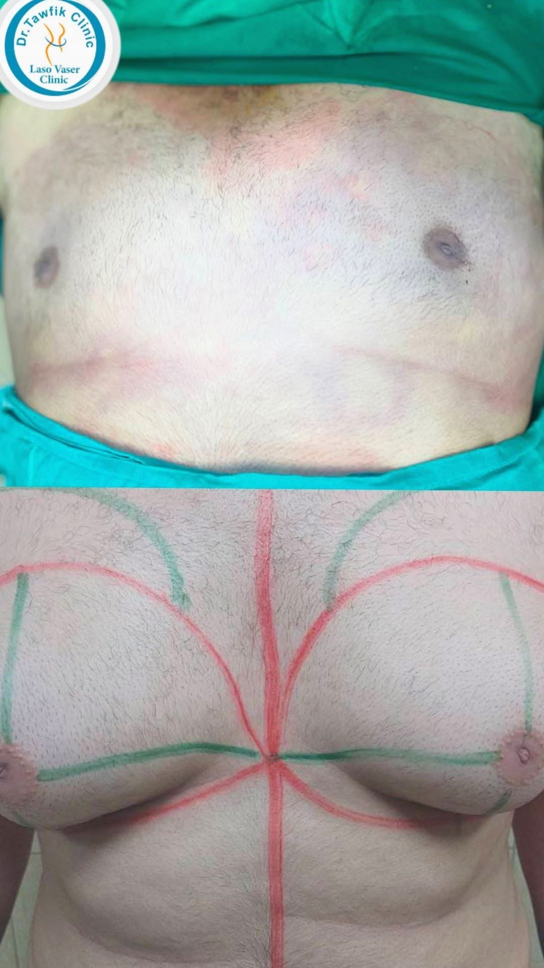 صورة قبل وبعد من ألبوم حالات علاج التثدي — الحالة 10