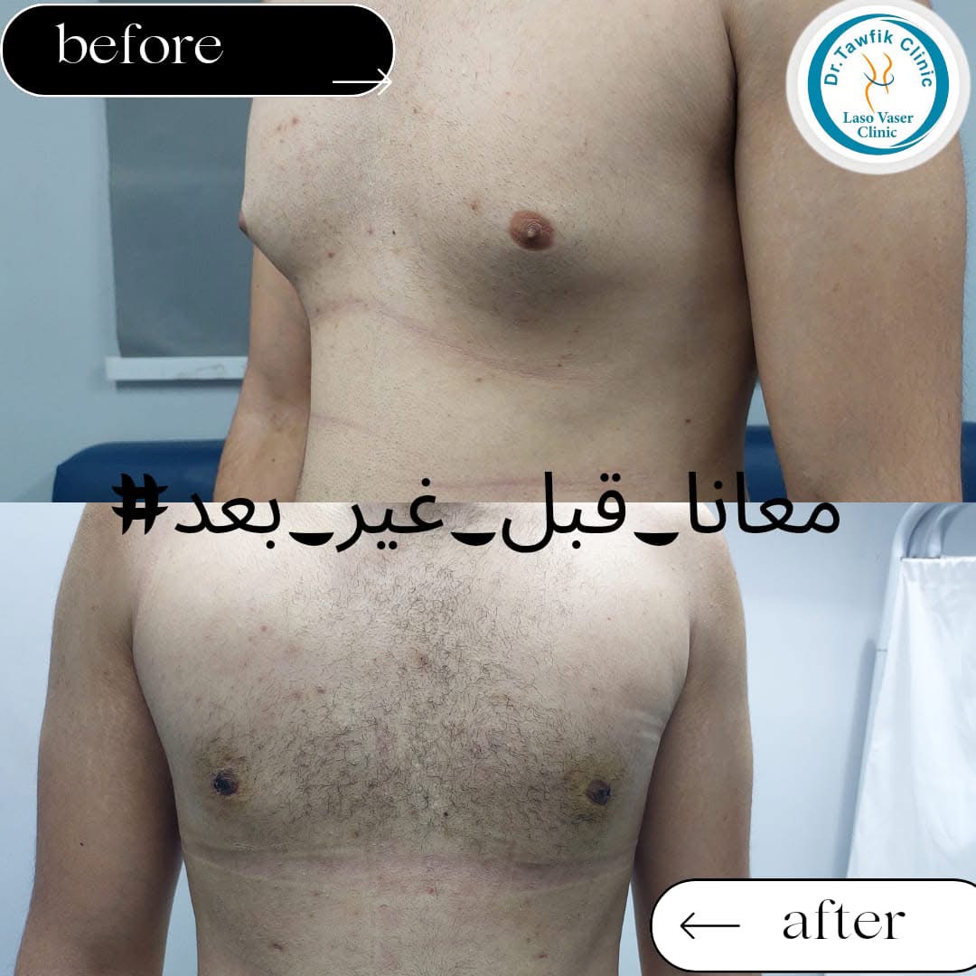 صورة قبل وبعد من ألبوم حالات علاج التثدي — الحالة 11