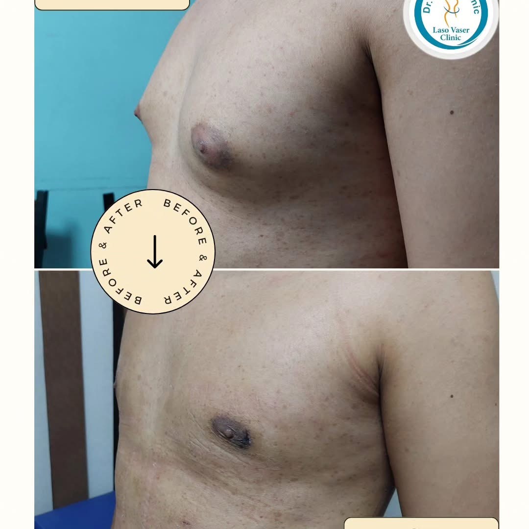 صورة قبل وبعد من ألبوم حالات علاج التثدي — الحالة 15