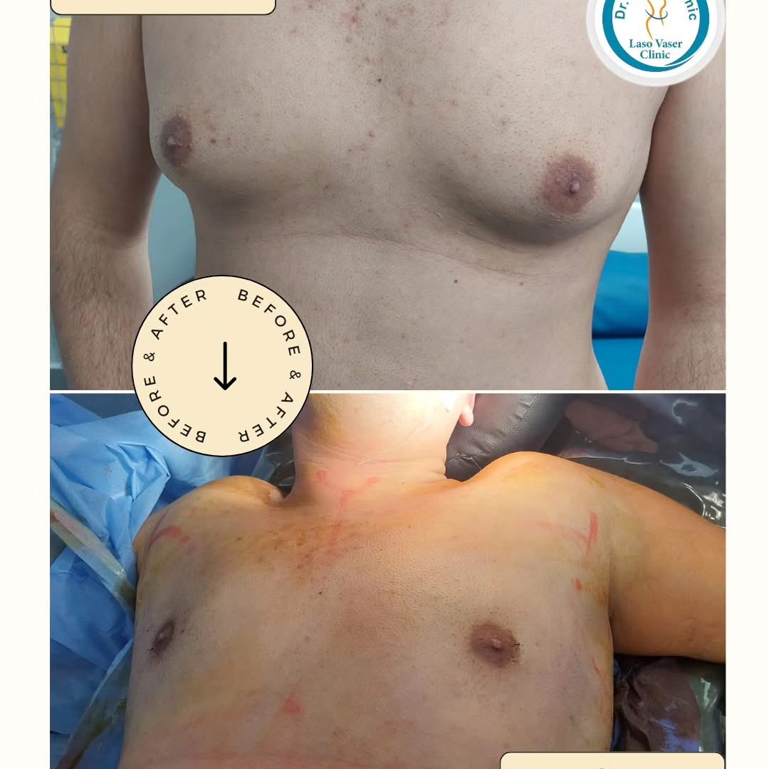 صورة قبل وبعد من ألبوم حالات علاج التثدي — الحالة 16